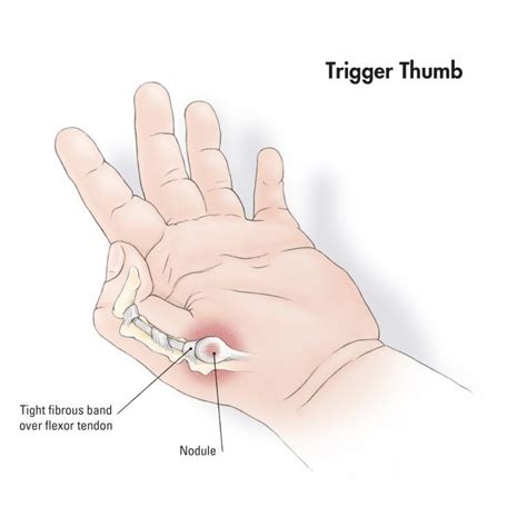 Trigger Thumb | Trigger thumb, Trigger thumb treatment, Trigger finger exercises