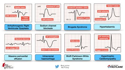 What Can Cause Abnormal Ecg Results - Printable Templates Protal