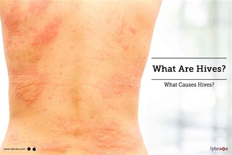 Urticaria Hives Causes Symptoms And Treatments