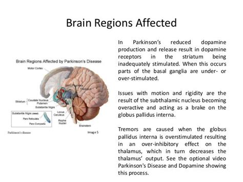 Understanding the Brain: Final Project - Parkinson’s Disease