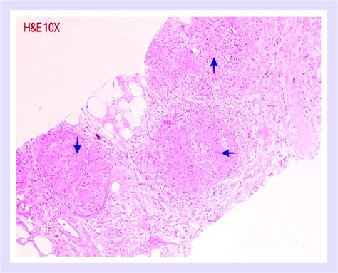 Histopathology 4a; Omental biopsy(10x H&E) 4b; Granulomas(blue arrow)... | Download Scientific ...