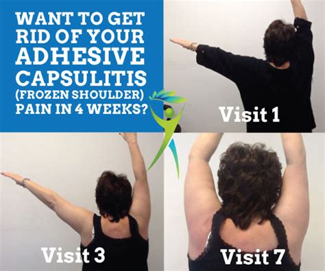 10 Years of Adhesive Capsulitis (Frozen Shoulder) Pain 90% Gone in 7 Treatments