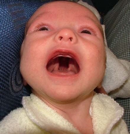 Medical Pictures Info – Cleft Palate picture