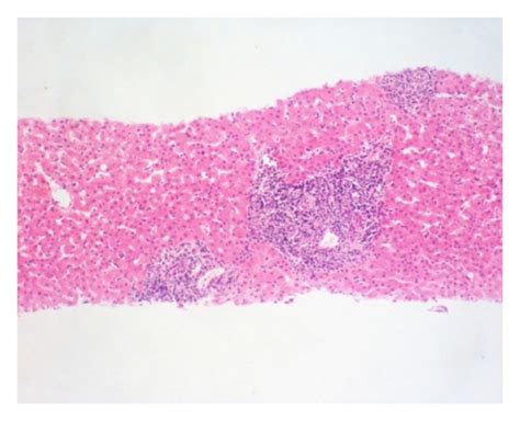 Histopathology of IgG4-related sclerosing cholangitis. The surgical... | Download Scientific Diagram