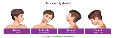 Types of cervical dystonia