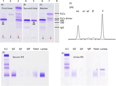 Protein Electrophoresis Result Serum Abnormal - Protein Info