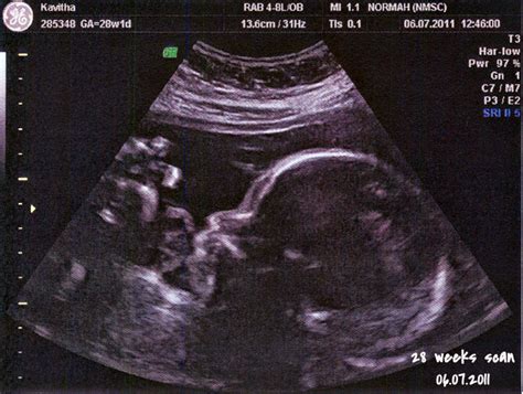 Ruthies's Journal: 28 Weeks 2D & 3D/4D Ultrasound Scan Photos