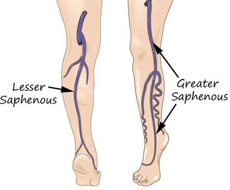 Varicose veins - Symptoms, Causes and Treatments - MedFog