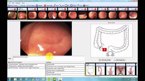 Colonoscopy report example using ProVationMD (with mouseover clicks ...