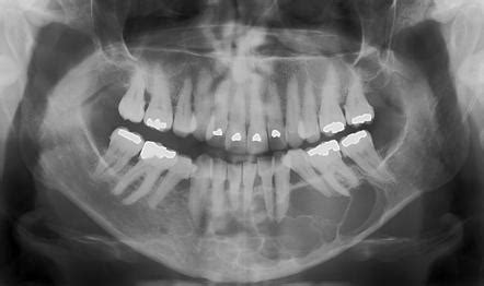 Botryoid Odontogenic Cyst