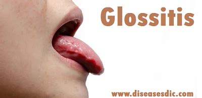 Glossitis – Causes, Treatment and Prevention