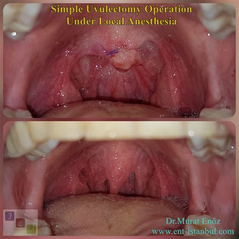 Elongated (Long) Uvula Causes, Symptoms and Treatment