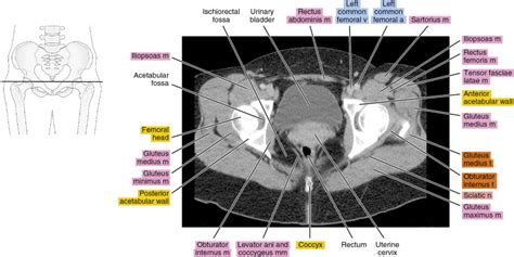 CT of the female pelvis | Radiology Key