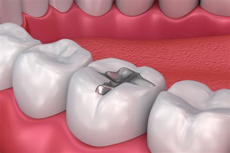 How Fillings Have Changed Over the Years - from 123Dentist