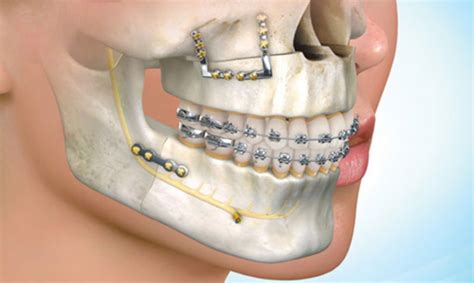 Maxillofacial Surgery – Silam Dental Clinic