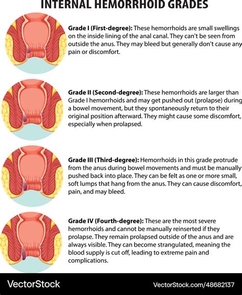 Educational infographic internal hemorrhoid grades