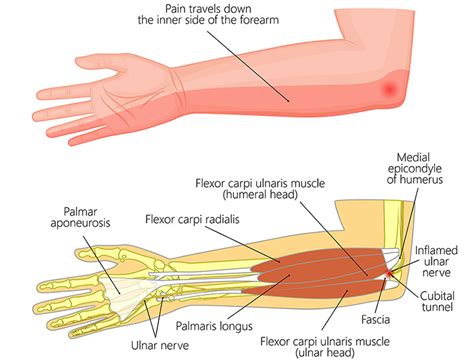 Ulnar Nerve Transposition | Ulnar nerve, Nerve, Muscle and nerve