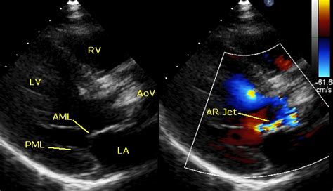 Pvc Echo Parasternal Long Axis View Aortic Stenosis Youtube