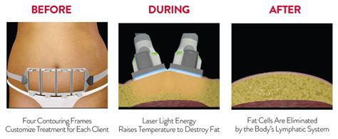 Sculpsure process - Vanish Laser Clinic Alexandria VA