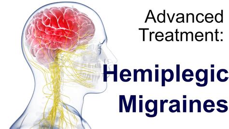 Hemiplegic Migraine Treatment - YouTube