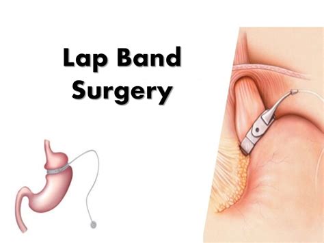 All You Need To Know About Lap Band Surgery