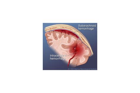 What are three main kinds of brain bleeding? - Godoy Medical Forensics