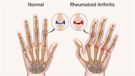 Causes and Natural Remedies for Rheumatoid Arthritis Linked to Poor Immune Health | 1MD Nutrition™