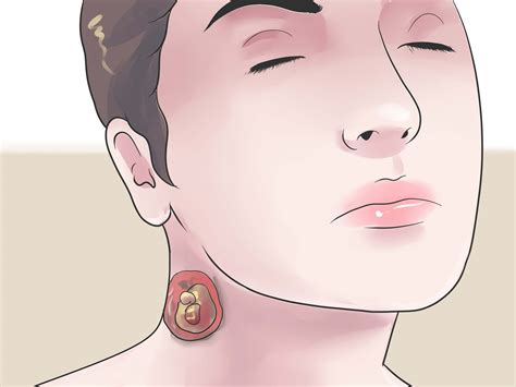 How to Treat an Infected Sebaceous Cyst (with Pictures) - wikiHow