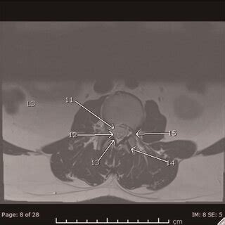 11. CSF within thecal sac, 12. Cauda equina, 13. Ligamentum flavum, 14 ...