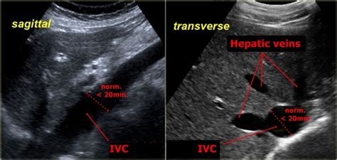 Inferior Vena Cava - Sonography | Medicína, nemoci, studium na 1. LF UK