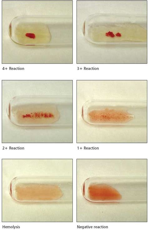 ~This is perfect~ Grading Agglutination Reactions | Medical lab technician, Medical laboratory ...