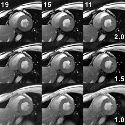 Spatial vs temporal resolution in real-time radial FLASH CMR.... | Download Scientific Diagram