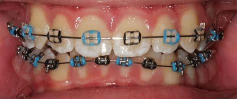 Braces Colours - Show off your personality with colour!