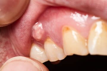 Tooth Abscess: What You Need to Know - REPC