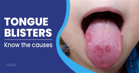 Tongue Blisters - Causes and Treatments