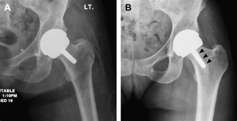 Imaging of Metal-On-Metal Hip Resurfacing | Musculoskeletal Key