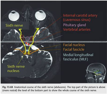 Cranial Nerve Palsy Mri