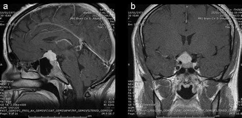 Suprasellar meningioma presenting with an altitudinal field defect ...