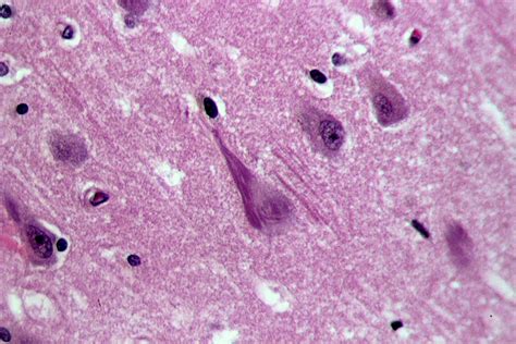 Neurofibrillary Tangles