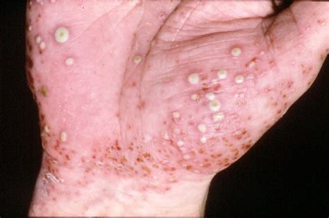 What does pustular psoriasis look like and how is it different?