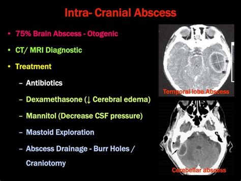 Complications of CSOM (Chronic Suppurative otitis Media) | PPT