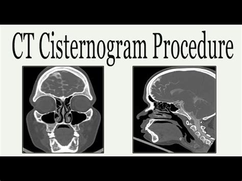 Cpt Code For Ct Cisternogram - 07/2021