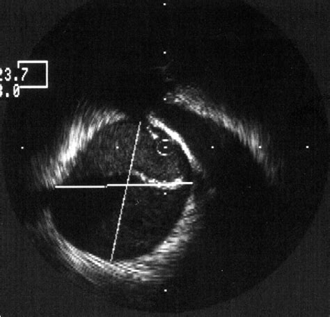 Figure 1 from Endoluminal Repair of Infrarenal AAA in the Presence of Aortic Dissection ...