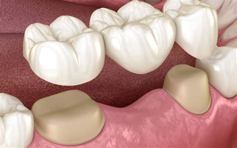 Dental Bridge - Types, Advantages & Process - Safar Medical