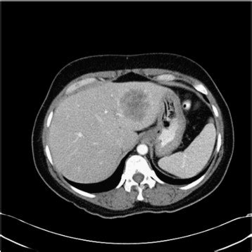 Large heterogeneous, predominantly hypodense lesion within the left... | Download Scientific Diagram