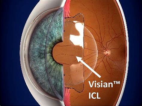 Phakic Implantable Collamer Lens (ICL) - CarlinVision