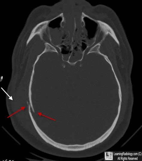 Learning Radiology - Depressed Skull Fracture