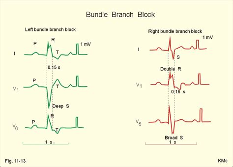 lbbb vs rbbb Book Covers