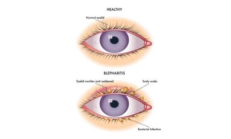 Blepharitis and Warm compress - Asia Retina Singapore