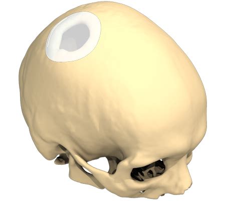 Cranial custom implant to correct the cranial vault